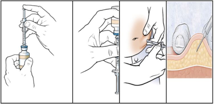Cách tiêm insulin đúng kỹ thuật tại nhà