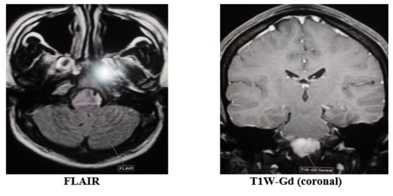 Nhân một trường hợp u màng não lờ chậm