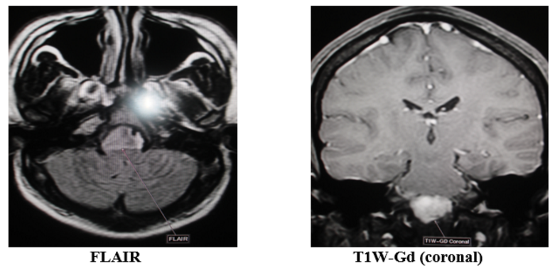 Nhân một trường hợp u màng não lờ chậm
