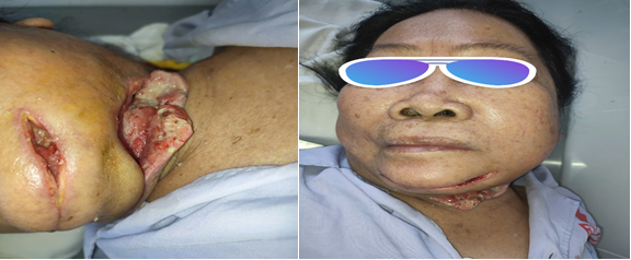 Khoa Tai Mũi Họng, Bệnh viện Quân y 121 điều trị thành công áp xe cổ sâu trên bệnh nhân đái tháo đường