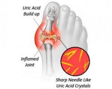 Bệnh gout và các nhóm thuốc điều trị