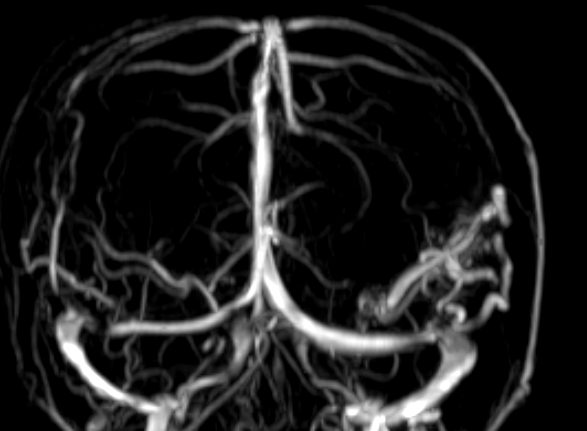 Nhân một trường hợp động kinh do dị dạng mạch máu não (AVM).
