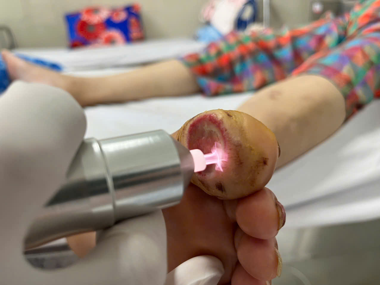 ĐỘT PHÁ TRONG ĐIỀU TRỊ VẾT THƯƠNG: KHOA CƠ XƯƠNG KHỚP – NỘI TIẾT ỨNG DỤNG THÀNH CÔNG CÔNG NGHỆ PLASMA LẠNH